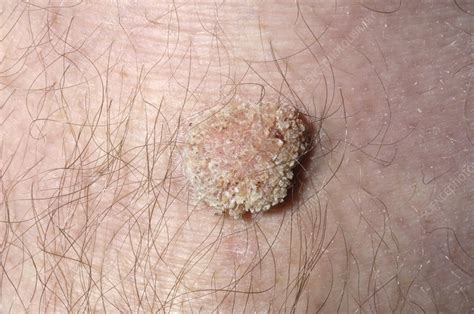 Wart On Knee Stock Image M2900179 Science Photo Library