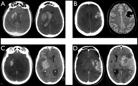 Predictive Value Of Flat Panel Ct For Haemorrhagic Transformations In
