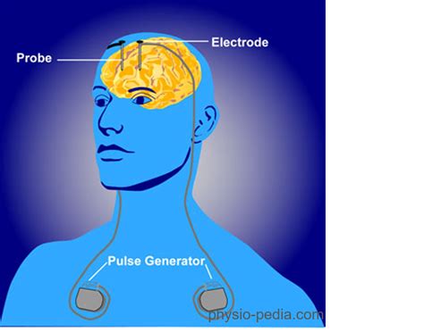 Deep Brain Stimulation Das Gehirn Unter Strom Hirn Und Weg