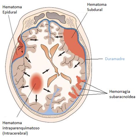 Hemorragia Cerebral Cirugía Neurológica Integral de Oriente