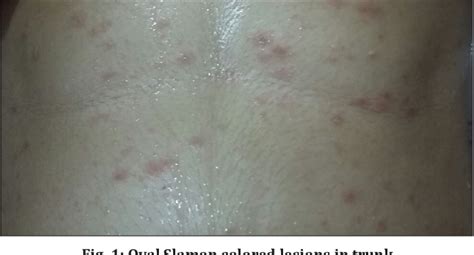 Figure 1 From Pityriasis Rosea Mimicking Polymorphic Eruptions Of