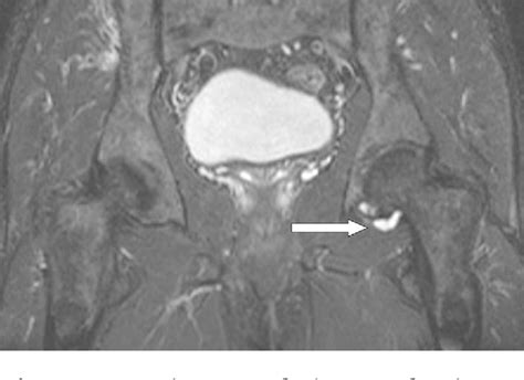 Figure 1 From A Paralabral Cyst Of The Hip Joint Causing Sciatica Case