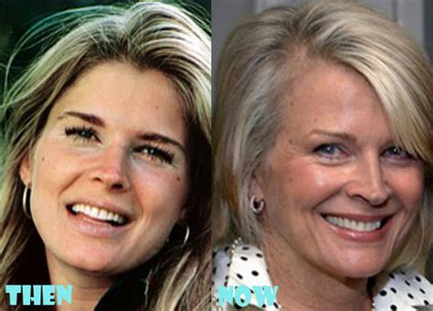 Candice Bergen Plastic Surgery Before And After Pictures Lovely Surgery