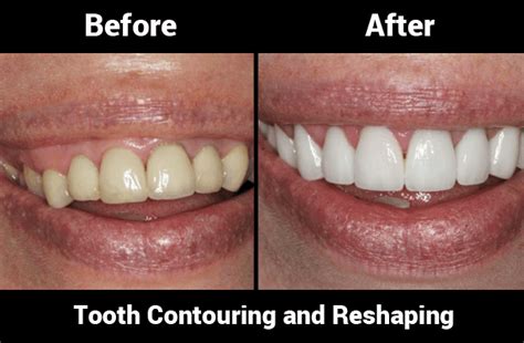 Tooth Reshaping And Dental Contouring In Nyc