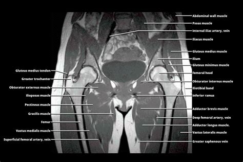 Mri Pelvis