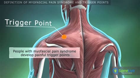 Myofascial Syndrome Trigger Points Chart A Visual Reference Of Charts Chart Master