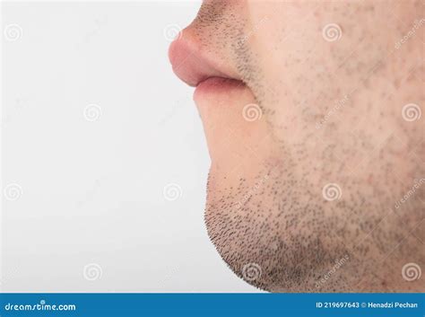 A Man Has A Large Upper Lip Close Up Reduction And Correction Of Lips