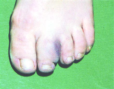 Painful Swelling Of The Second Toe Of The Left Foot In A 49 Year Old
