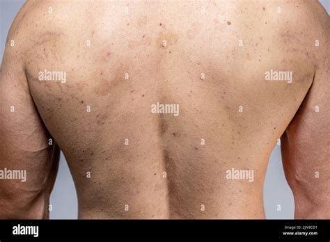 Tinea Versicolor On The Back Pityriasis Versicolor Problem With Skin Stock Photo Alamy