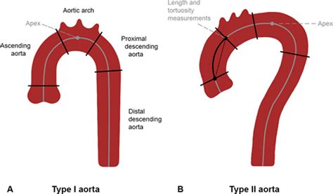 Aortic Elongation Part I The Normal Aortic Ageing Process Heart