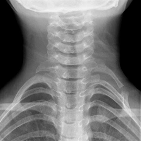 Utah Pediatric Radiology Case Of The Week Hard Left Supraclavicular Mass