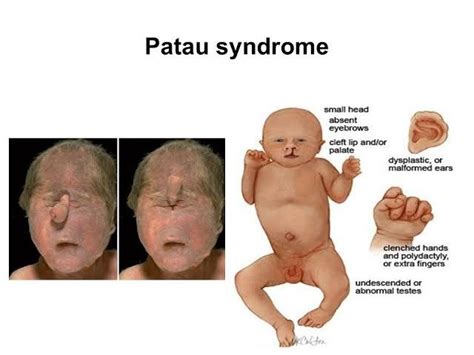 Pin By Harryygr On Genetics Patau Syndrome Cleft Lip Clenched