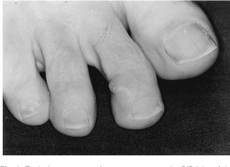 Figure 1 From Treatment Of Mucous Cysts Of The Toes Semantic Scholar