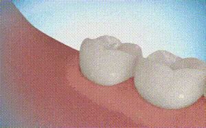 Having your wisdom teeth removed can be a daunting procedure to prepare for, however, the routine surgery is one with minimal risks. Wisdom Tooth GIF - Find & Share on GIPHY