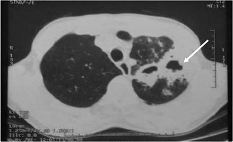 Pulmonary Actinomycosis Mimicking Lung Malignancy About Two Cases Heliyon