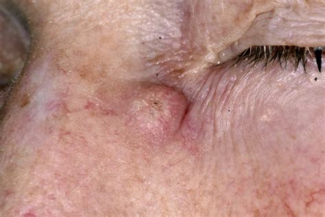 Keratoacanthoma Skin Cancer Stock Image C0284428 Science Photo