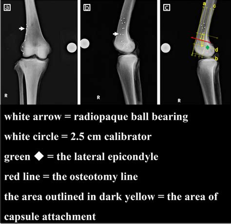 Radiography Of The Marked Capsule Attachment Of The Lateral Distal