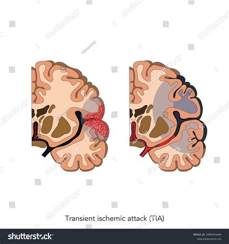 117 Transient Ischemic Attack Images Stock Photos And Vectors Shutterstock