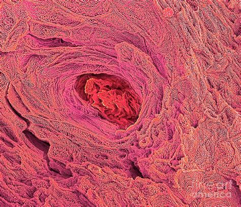 Blocked Sweat Gland Photograph By Steve Gschmeissnerscience Photo Library
