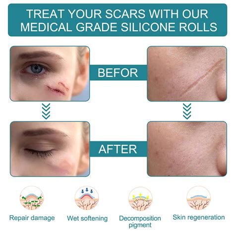 Buy Silicone Scar Removal Sheets Tapetreatment For Old And New Scars