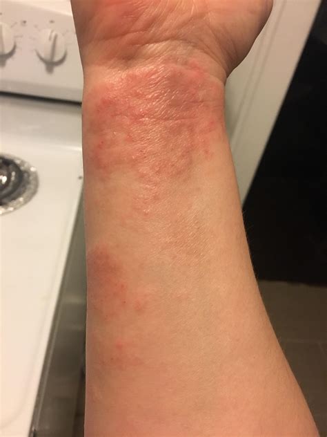 Ringworm Or Eczema My Bf Got Ringworm Months Ago And I Got A Spot That