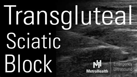 Transgluteal Sciatic Nerve Block Youtube