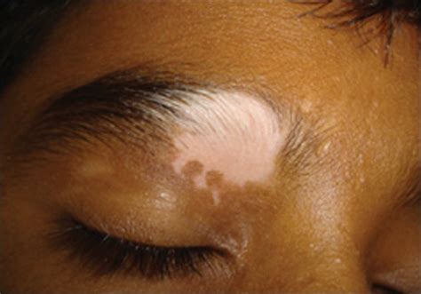 Childhood Vitiligo Palit A Inamadar Ac Indian J Dermatol Venereol Leprol