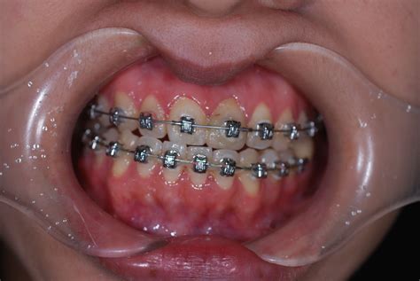 Orthodontics - U-Dental Clinic