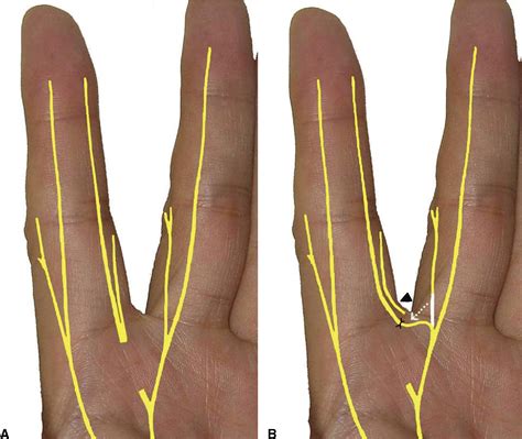 Finger Sensory Reconstruction With Transfer Of The Proper Digital Nerve