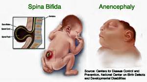 Image result for Anencephaly causes, symptoms & treatments