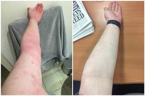 Review My Eczema Went From This To This Using Salt Liverpool Echo