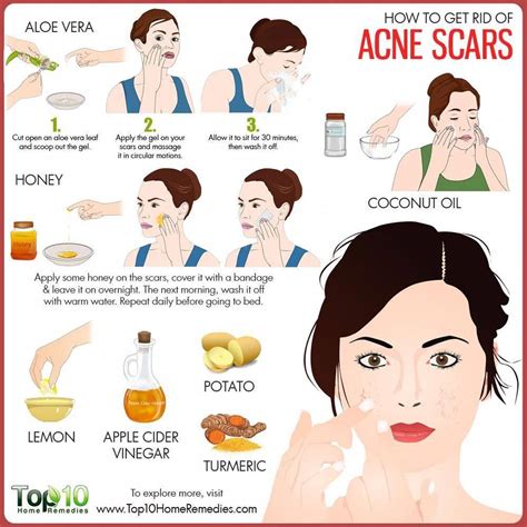 Acne Quick Tips Myvins My Id
