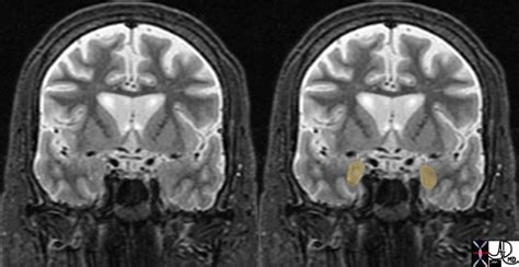 Amygdala Brain