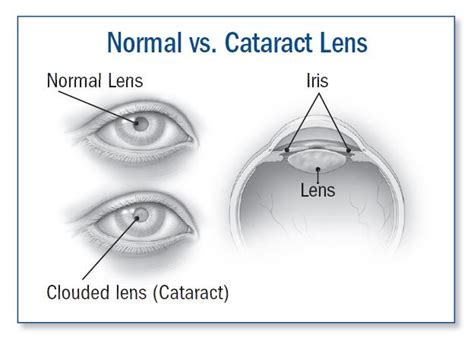 Cataract Symptoms Diagnosis And Treatment Harvard Health