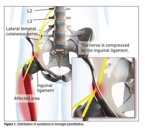 Accurate Education Meralgia Paresthetica