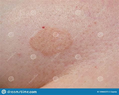 Fungal Skin Rash Infection Mark Close Up Of Patch Stock Image Image