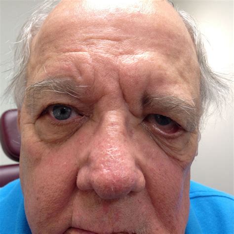 Bells Palsy What Are The Treatment Options In Denver If You Cant