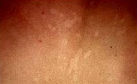 Brown Patches On Skin