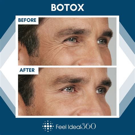 Botox Before And After Man Wrinkles Feel Ideal 360 Med Spa