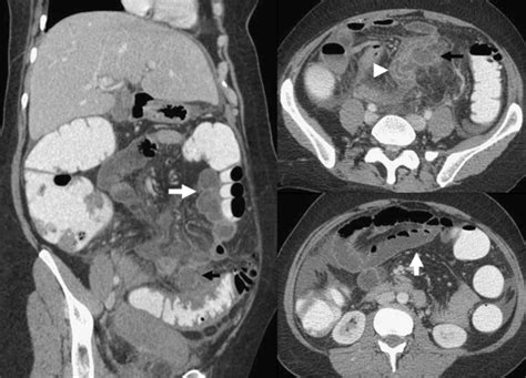Sigmoid Diverticulitis With Abscess Formation Black Arrows Associated