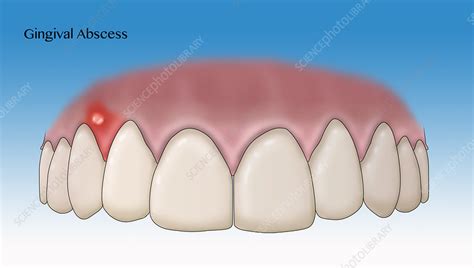 Gingival Abscess Illustration Stock Image C0366287 Science