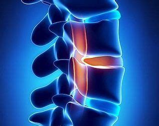 But with proper knowledge, attention, and care, you can get rid of the affliction and bring your life back today, a slipped disc is a major cause of concern among many, and most sufferers are youngsters. Bulging Discs - Fort Worth, TX - Texas Injury Clinic