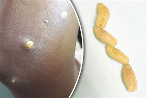 A small creature such as a fly or ant, t.: Tumbu flies afflict UK woman: Larvae needed surgical ...