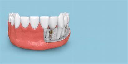 Dental Implants Solid Implant Tooth Ideal Needs