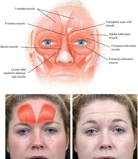 Frontalis Muscle Anatomy Facial Muscle Anatomy Top And Morphology