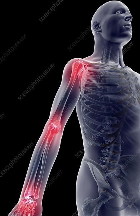 Arm Joint Pain Stock Image C0081330 Science Photo Library