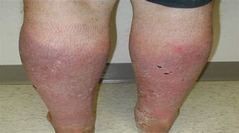 Acute Venous Stasis Dermatitis