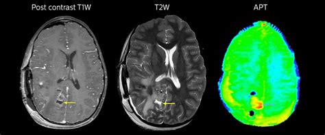 Enhancing Brain Tumor Mri With Apt Weighted Imaging Fieldstrength