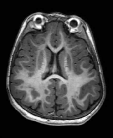 Pediatric Radiological Case Pelizaeus Merzbacher Syndrome Radiology