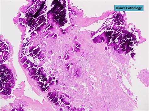 Qiaos Pathology Aortic Valve Vegetation And Bacterial En Flickr